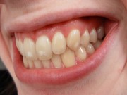 Зубы Тернера
