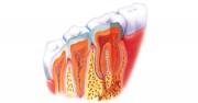 Лечение флегмоны зуба