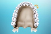Исправление транспозиции зуба