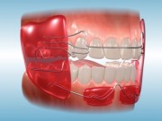Обзор элементов ортодонтических аппаратов