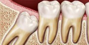 Импактные и ретинированные зубы