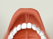 Пластика уздечки верхней губы