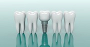 Как выбрать клинику для имплантации зубов