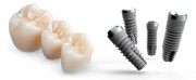 Импланты на жевательные зубы