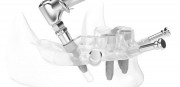 3D имплантация зубов