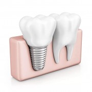 Короткие импланты зубов