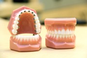 Установка внутренних брекетов в стоматологии
