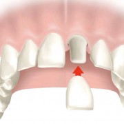 Удлинение зубов
