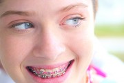 Установка брекетов детям в стоматологии