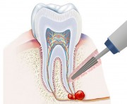 Киста зуба у пациентов