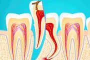Коронорадикулярная сепарация в стоматологии