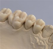 Восковое моделирование зубов
