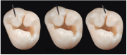 Индекс разрушения окклюзионной поверхности зубов
