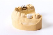 Молочные зубы на коронки