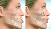 Компактостеотомия в ортодонтии