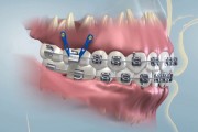 Скелетная опора в ортодонтии