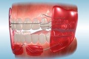 Функциональное ортодонтическое лечение