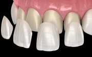 Накладки для реставрации передних зубов