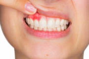 Воспаление надкостницы зуба