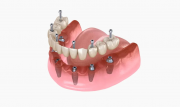 Методы протезирования при отсутствии зубов