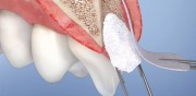 Гемостатические губки после удаления зуба