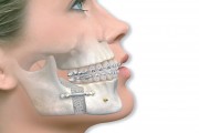 Раздельное ортодонтическое лечение челюстей
