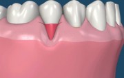 Оголение шейки зубных имплантов