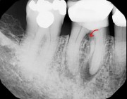 Бифуркация зуба