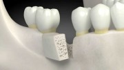 Костная пластика в стоматологии