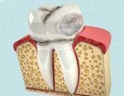 Некариозные поражений зубов