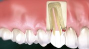 Можно ли восстановить нарощенный зуб