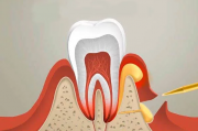 Причины воспаления корней зубов