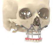 Скуловая имплантация в стоматологии