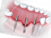 Отличия базальной и классической имплантации зубов