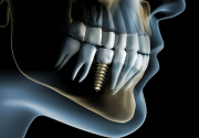 Какой снимок нужен для имплантации зубов