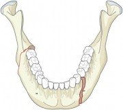 Переломы нижней челюсти