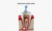 Последствия удаления нерва из зуба