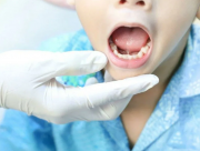 Подрезание уздечки под языком у детей