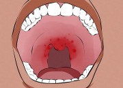 Эритроплакия полости рта