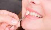 Реставрационное покрытие зубов