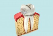 Некариозные поражения зубов