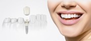 Гарантия на зубные импланты