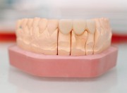 Признаки износа зубного протеза