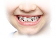 Искривление зубов у ребенка