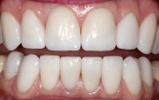 Реставрация зубов методом удлинения