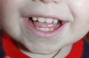 Белые пятна на молочных зубах