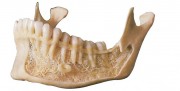 Остеопороз в стоматологии