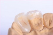 Зубные полукоронки