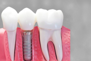 Почему на запломбированный зуб ставят коронки