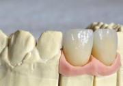 Отличия в коронках для фронтальных и боковых зубов